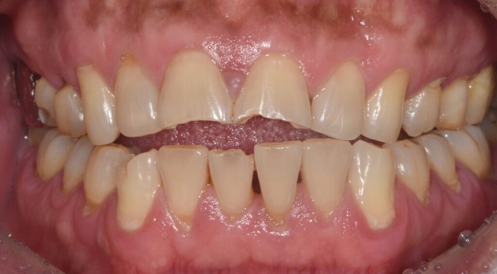 최소삭제 라미네이트