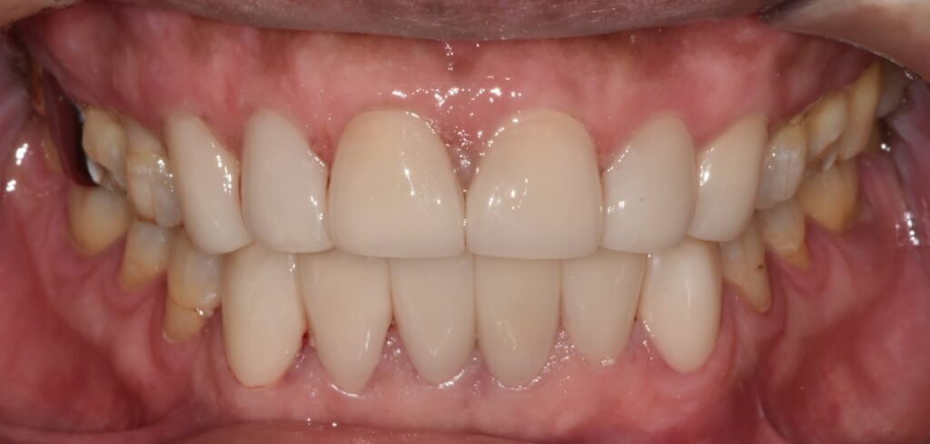 최소삭제 라미네이트