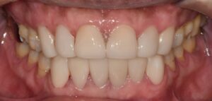 최소삭제 라미네이트