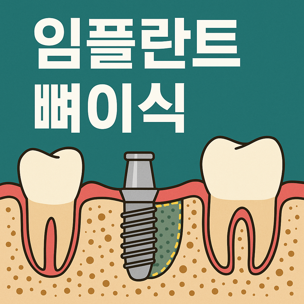 임플란트 뼈이식