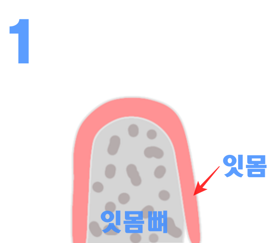 임플란트 뼈이식