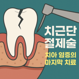 치근단 절제술