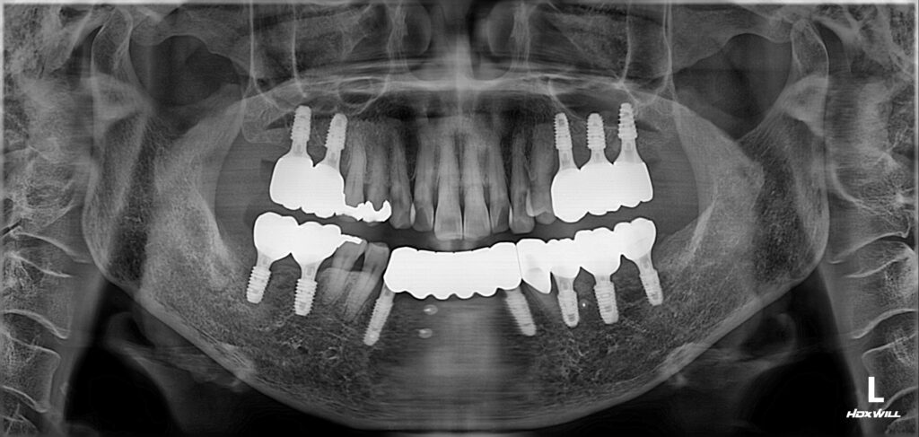 어금니 치아 흔들림