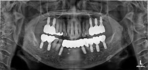 어금니 치아 흔들림