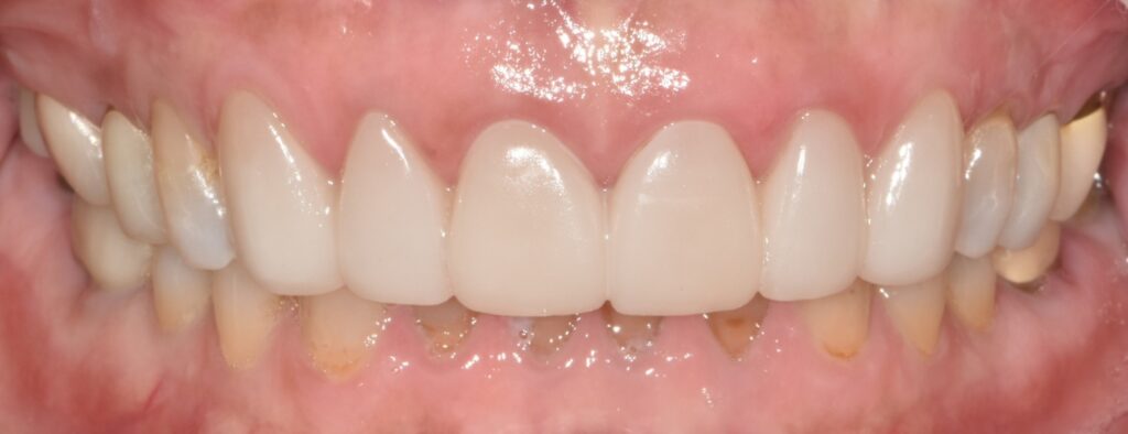 치아 라미네이트